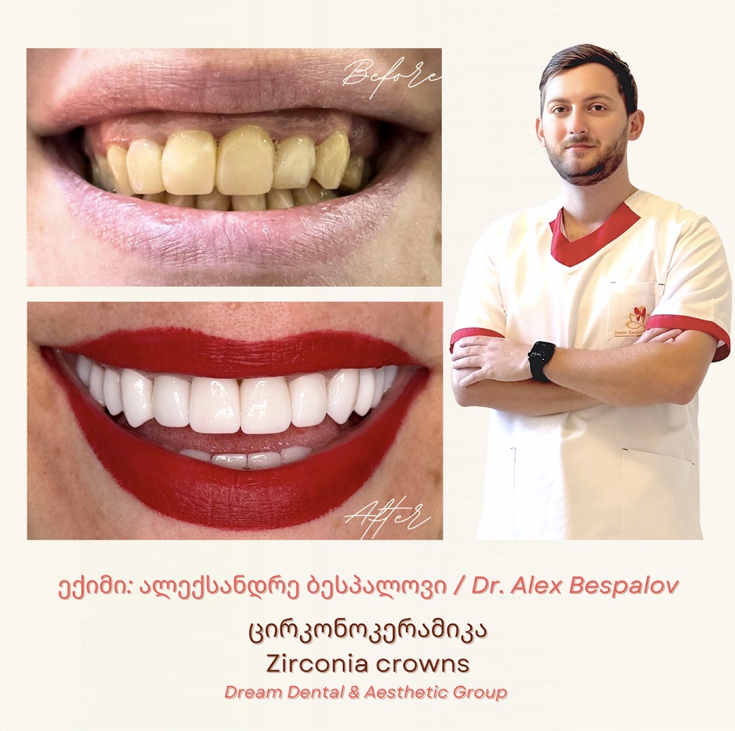 Real smile transformation by Dr. Alex Bespalov